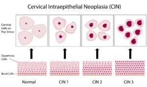 Colposcopy and pap smear is useful to detect pre-cancerous changes of the cervix