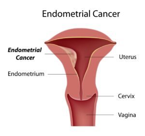 Endometrial cancer - Cancer of the lining of the womb