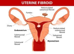 Hysterectomy for uterine fibroids